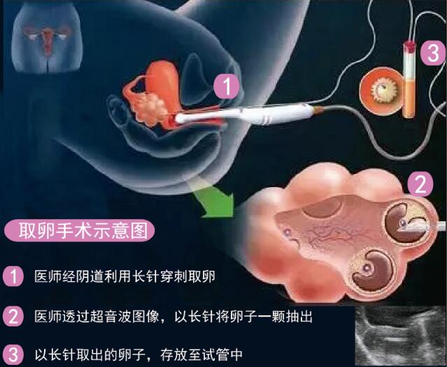 试管婴儿取卵手术过程是怎么样的