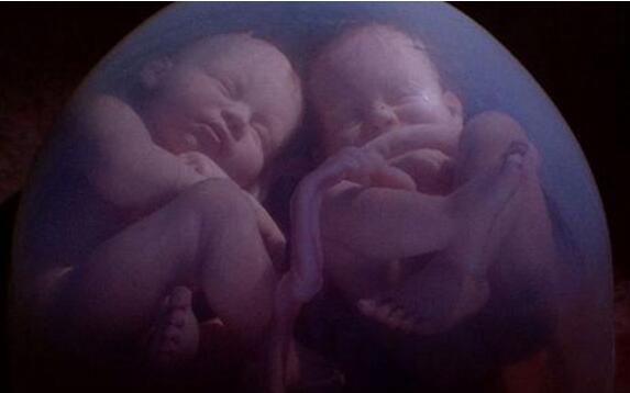 同卵双胞胎试管婴儿容易胎停育吗？如何防止胎停育